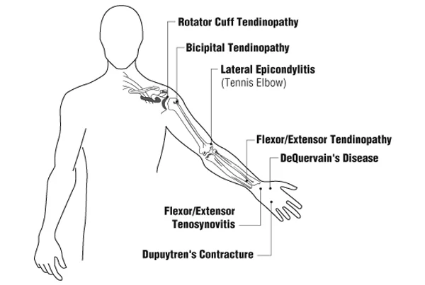 Bone Muscles and Tendon Disorders