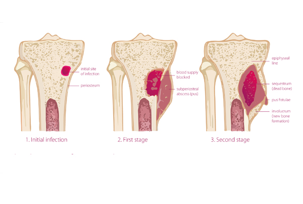 Orthopaedic Chronic Infections