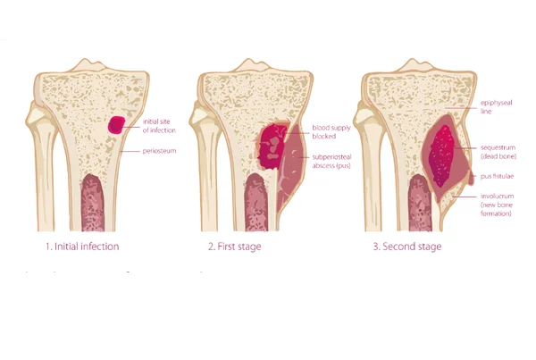 Orthopaedic Chronic Infections