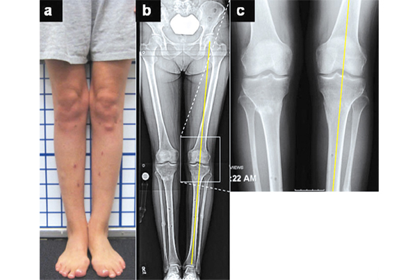 Limb Realignment Surgery