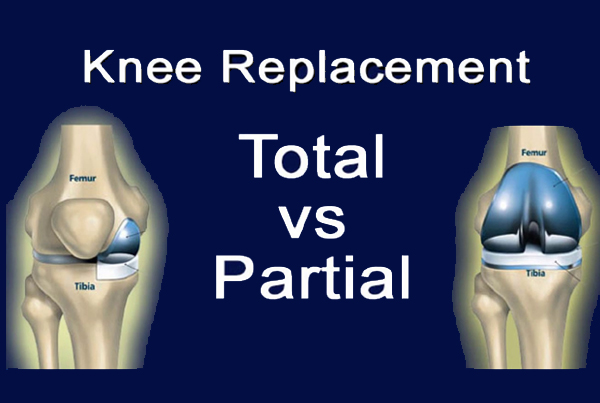 Total and Partial Knee Replacement Surgeries