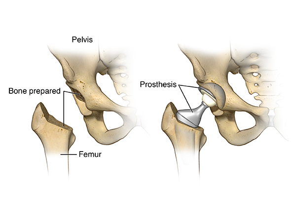Total and Partial Hip Replacement Surgeries