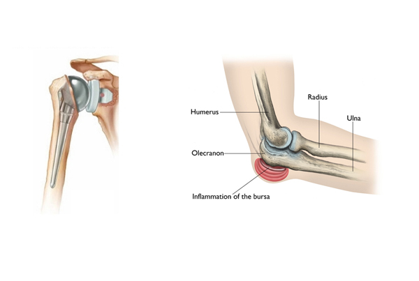 Shoulder and Elbow Replacement