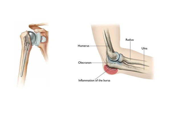 Shoulder and Elbow Replacement