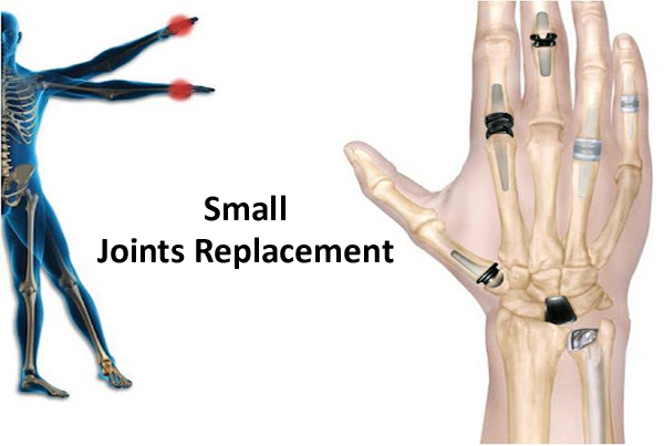 Arthroplasties