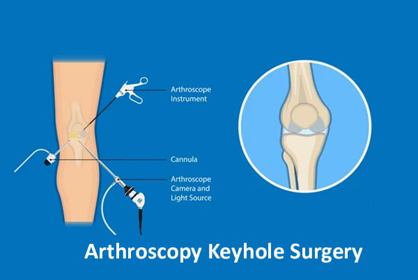 Arthroscopy key Hole Surgeries 
