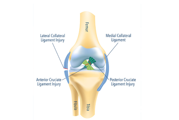 Multiligament Knee Injuries