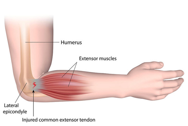 Shoulder and Elbow Sports Injury