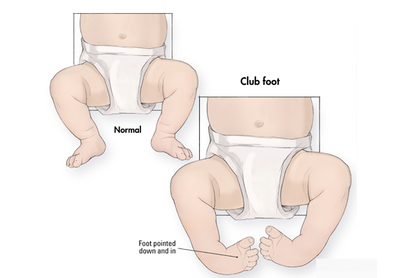 Clubfoot