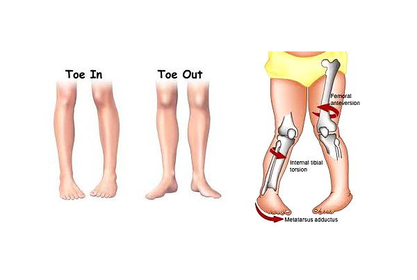 Knock Knees