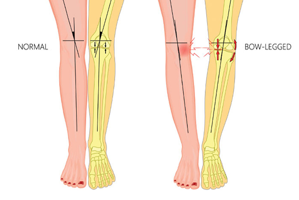 Bowed Legs