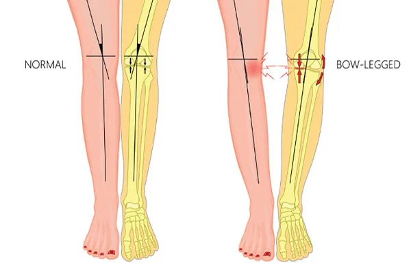 Bowed Legs