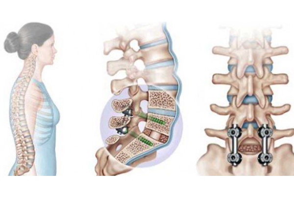 Spine Fixation