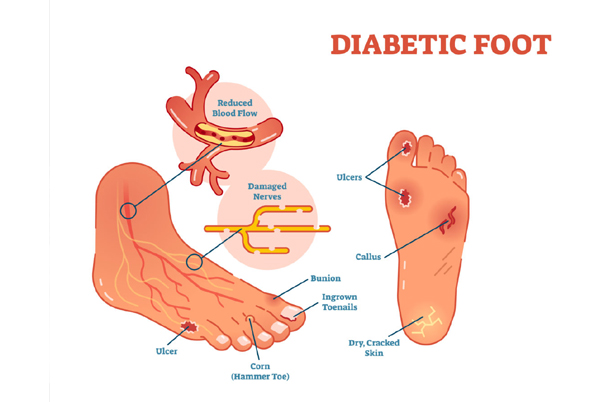 Diabetic Foot Issue