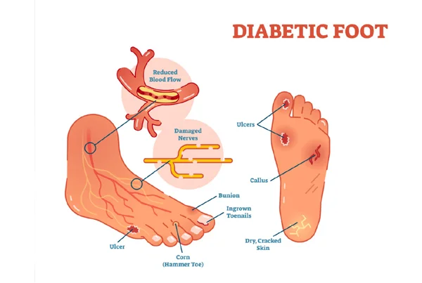 Diabetic Foot Issue