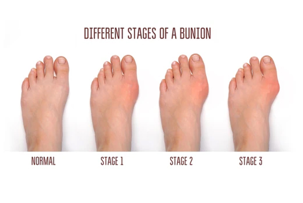 Bunions