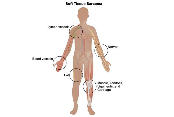 Advanced Bone and Soft Tissue Tumor Management
