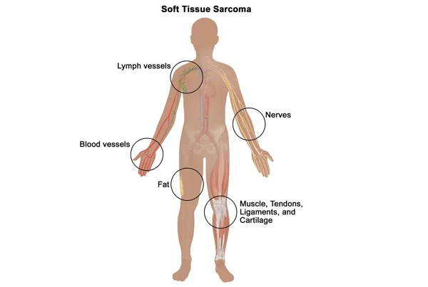 Advanced Bone and Soft Tissue Tumor Management